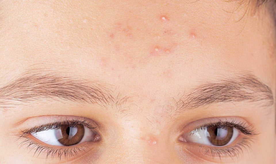 Whitehead Acne Treatment