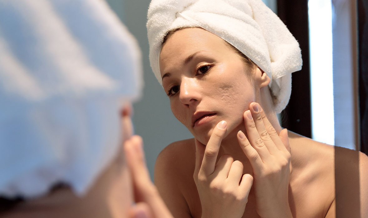 How to treat and prevent acne scars – Proactiv US