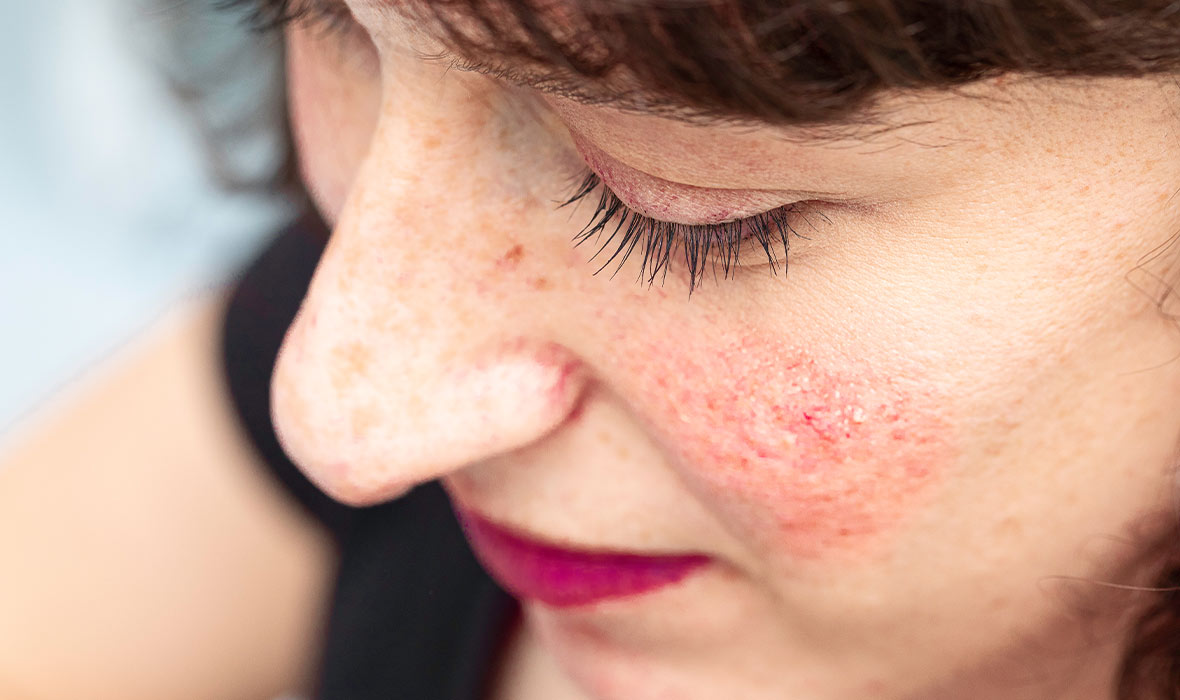 Rosacea & Acne