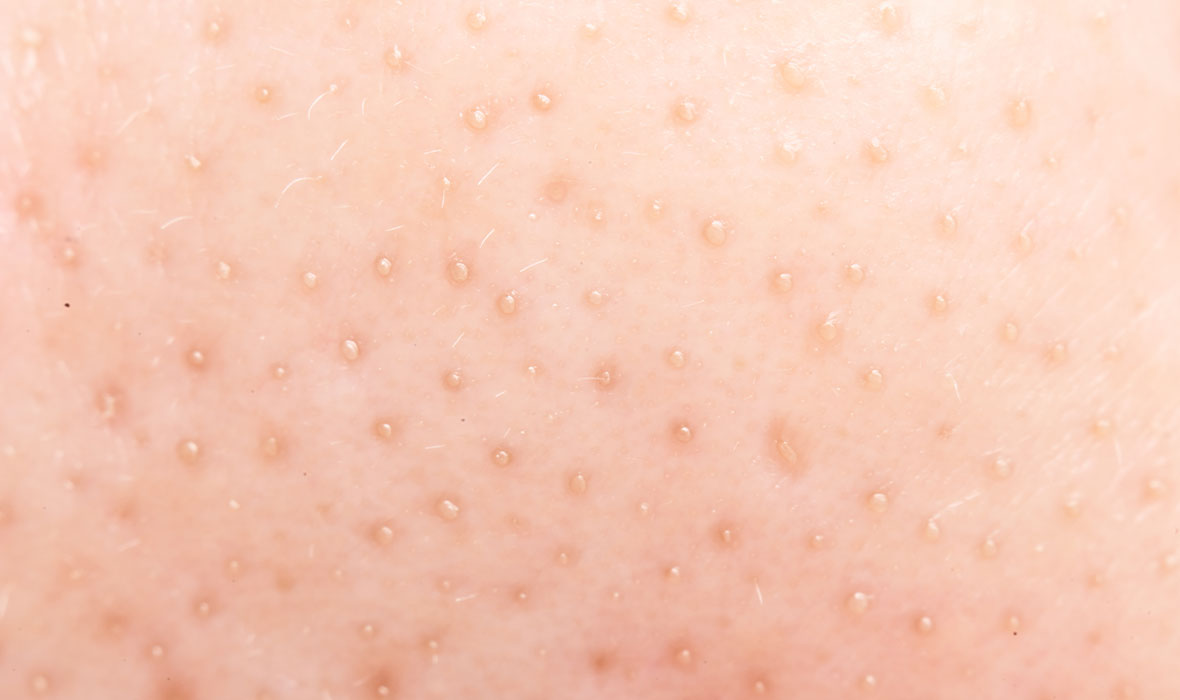 Blackheads vs. sebaceous filaments