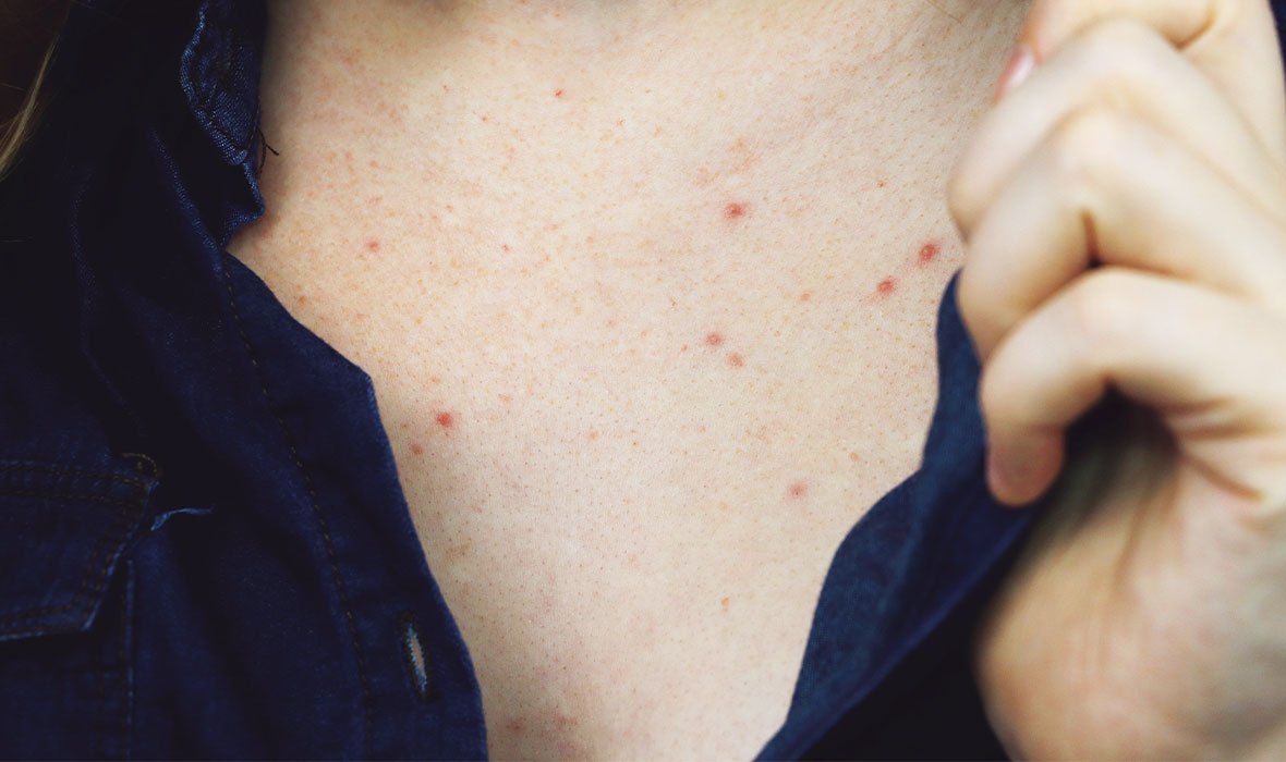 Why is my chest breaking out? – Proactiv US
