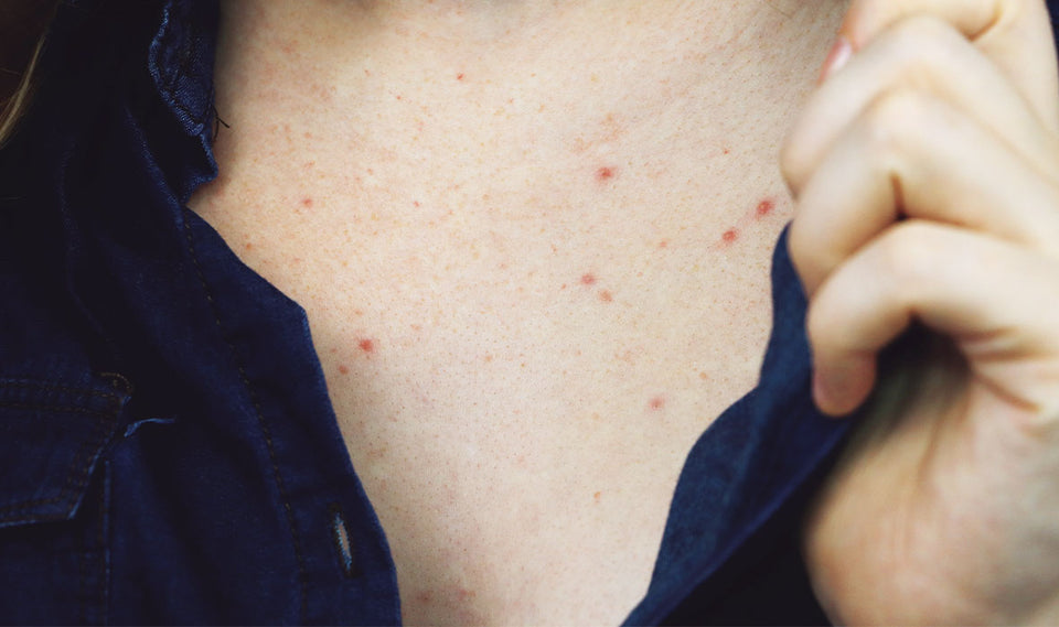 What Causes Chest Acne?