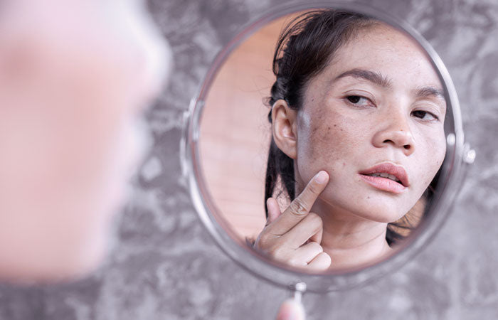 Acne Dark Spots & Marks