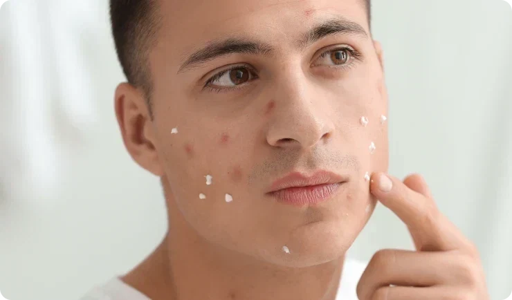 guy applying ointment on face pimples