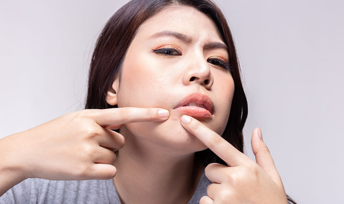 Signs of Hormonal Acne
