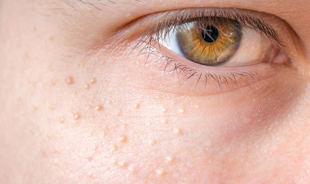 What Are Those Tiny Bumps On Your Face?
